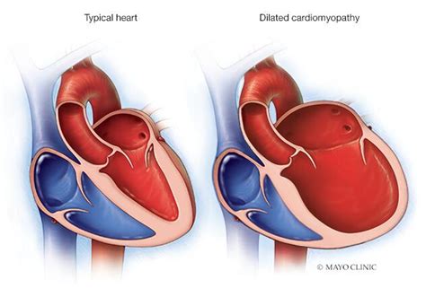 lv dilation open heart surgery|how to prevent dilated cardiomyopathy.